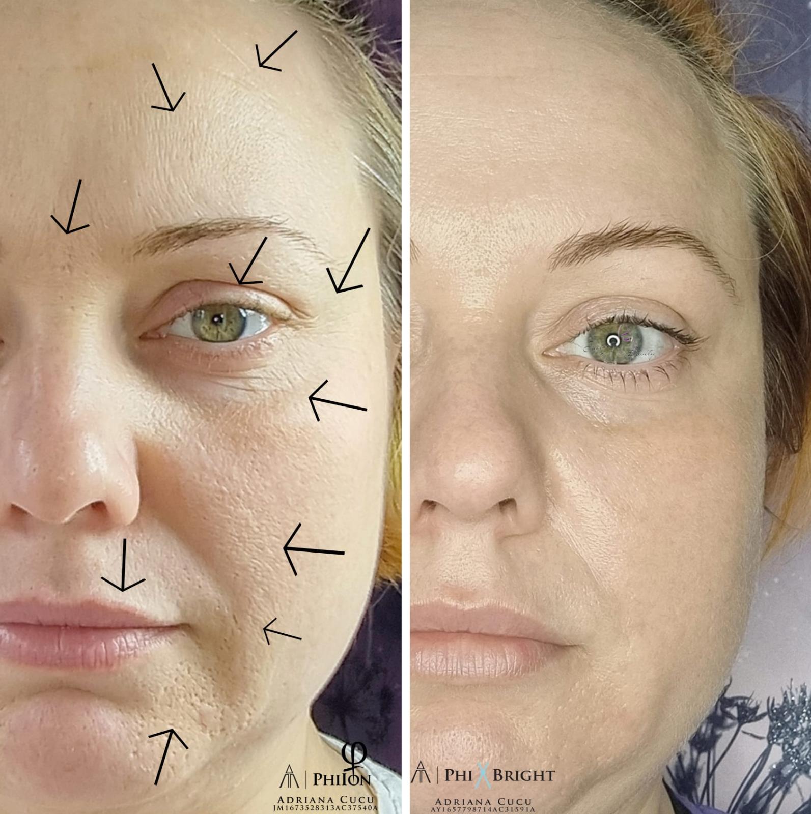 Microneedling session targeting facial skin for collagen stimulation and texture improvement