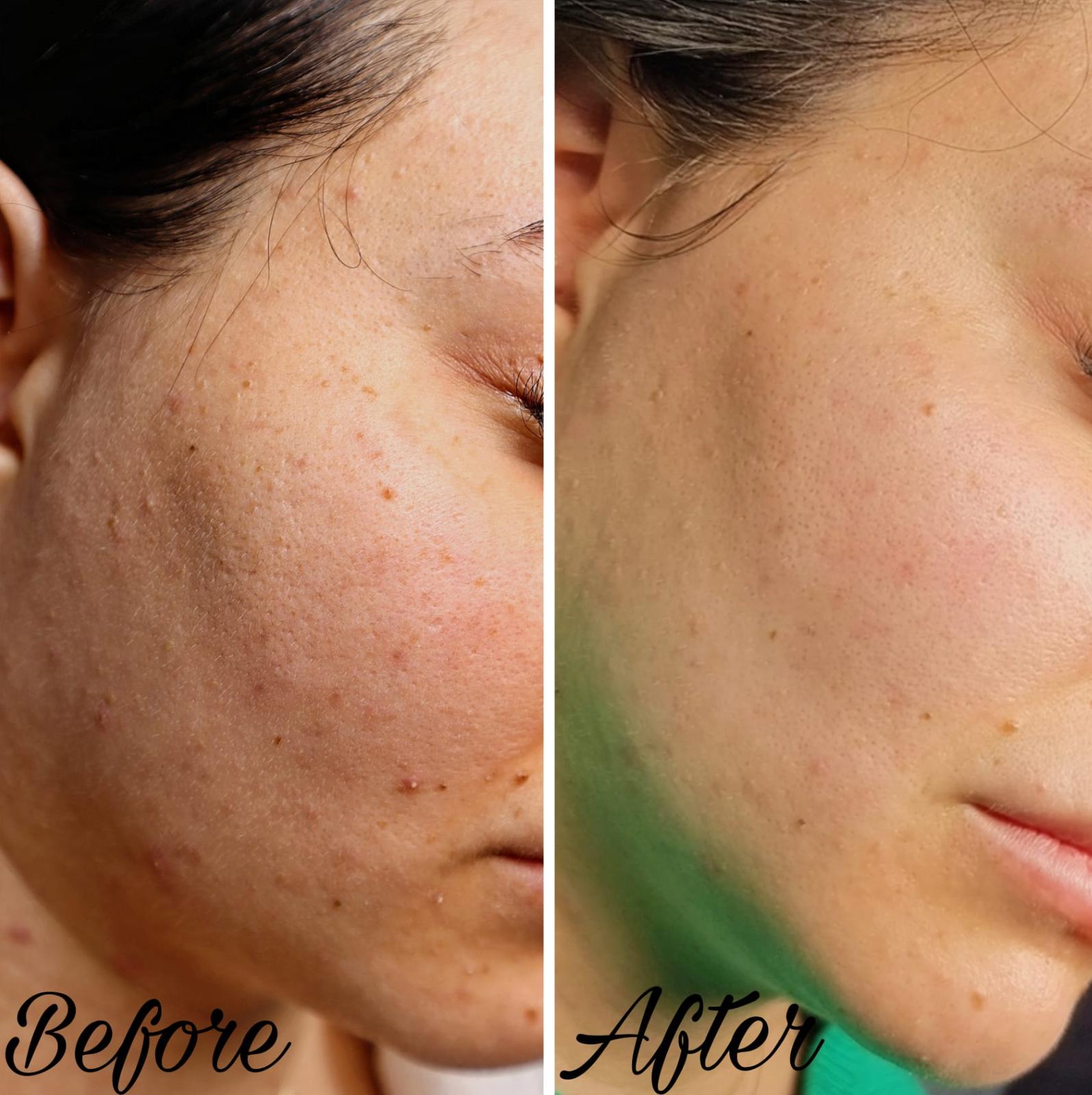 Dermaplaning facial treatment being performed to exfoliate and smooth the skin